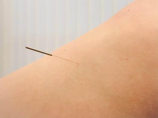 Vanessa Trevisan Acupuntura - Artrose e Artrite