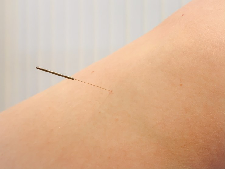 Vanessa Trevisan Acupuntura - Artrose e Artrite