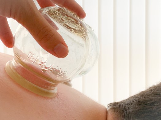 Vanessa Trevisan Acupuntura Ventosa