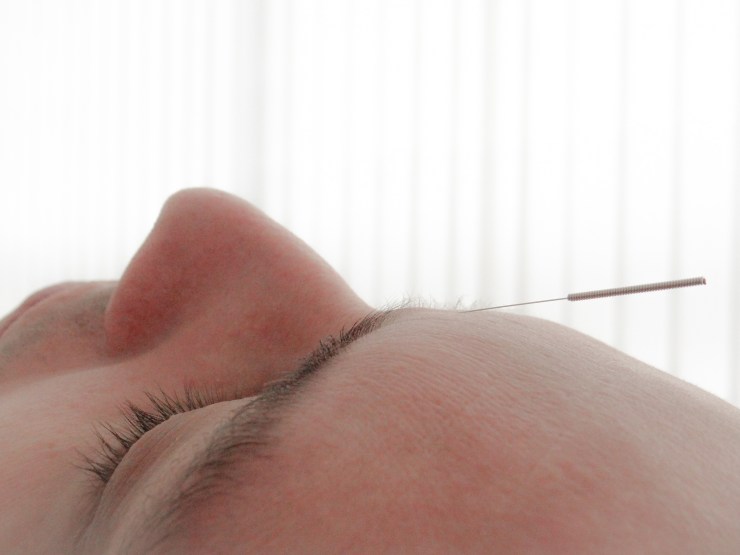 Vanessa Trevisan Acupuntura Estresse