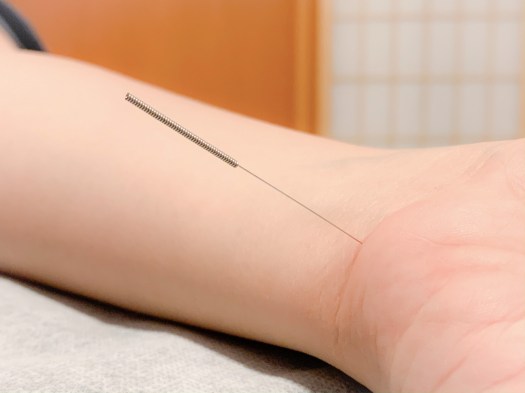 Vanessa Trevisan Acupuntura Ansiedade