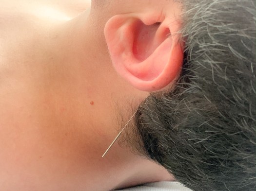 Vanessa Trevisan Acupuntura Insônia